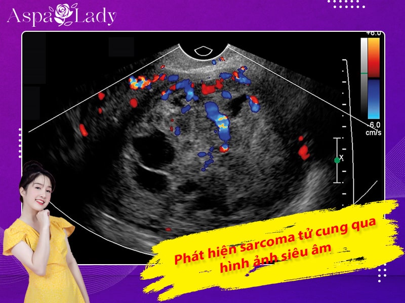 Phát hiện Sarcoma tử cung qua hình ảnh siêu âm