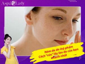 Nám da do mỹ phẩm: Cách “cứu” lấy làn da của bạn nhanh nhất