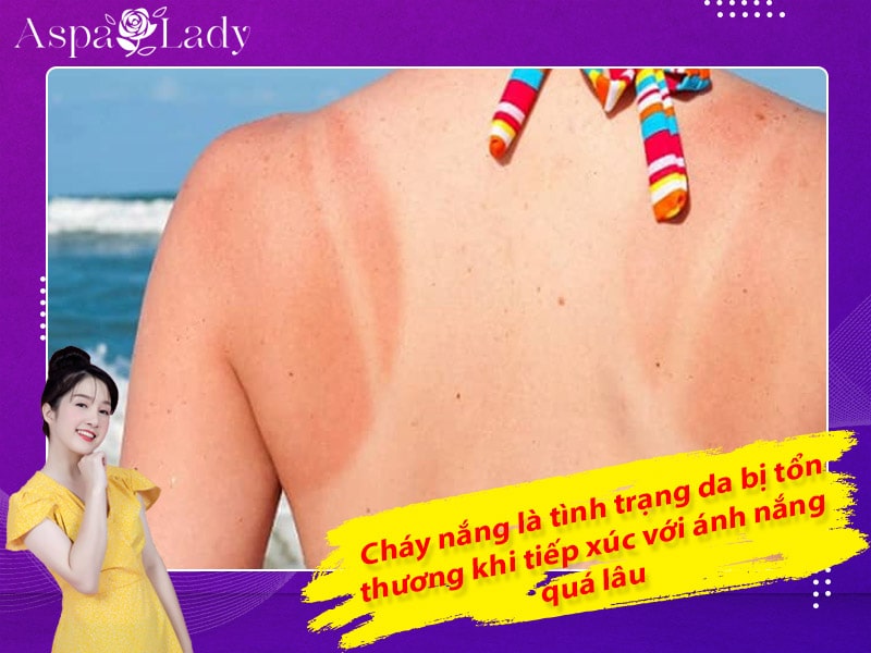 Cháy nắng là tình trạng da bị tổn thương khi tiếp xúc với ánh nắng quá lâu
