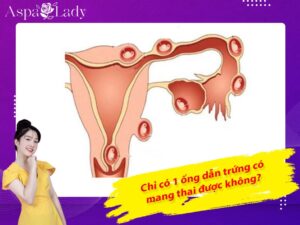 Chỉ có 1 ống dẫn trứng có mang thai được không?