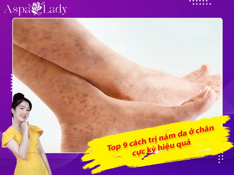 Top 9 cách trị nám da ở chân cực kỳ hiệu quả